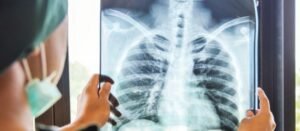 La tuberculosis permanece latente a pesar de ser una enfermedad que se previene